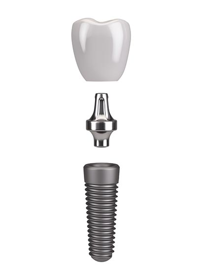 A titanium post is placed into the jawbone where the tooth is missing
