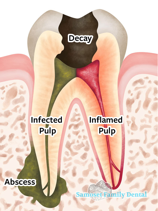 An infected “hot” tooth damaged by decay, abcess and inflamation