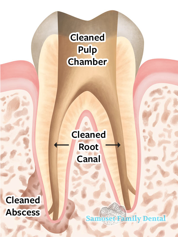 A tooth after infected pulp removal.