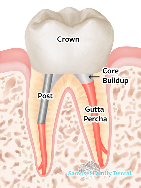 A Tooth after root canal therapy, post and core and crown restoration.