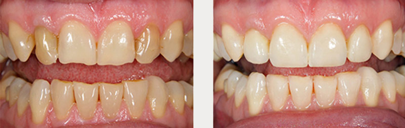 Images of a patient before and after veneers