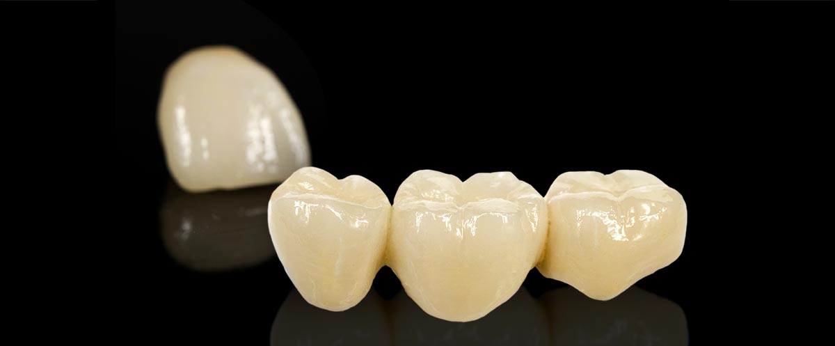 Dental Crowns and Bridges - Rose Dental Group